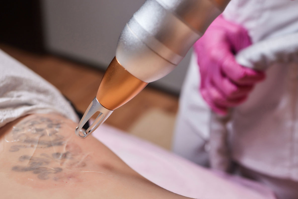 Eliminación de tatuajes y micropigmentación